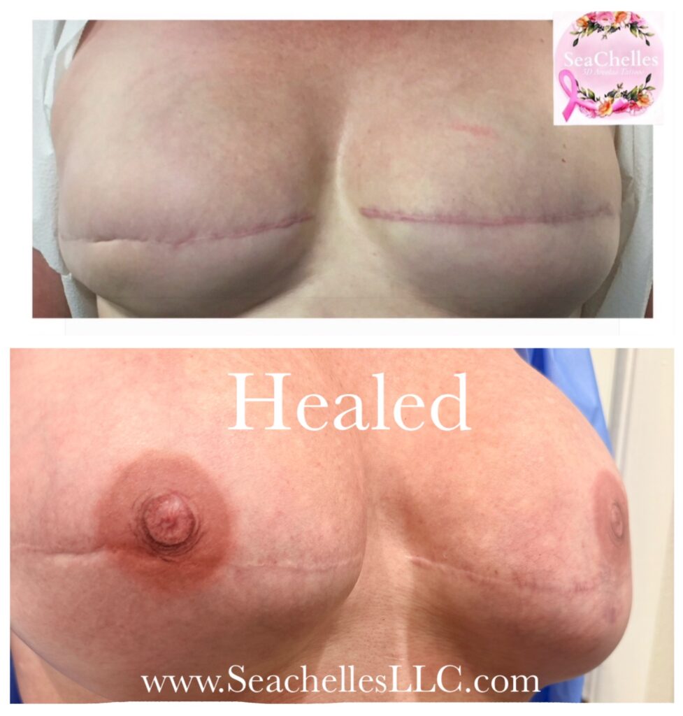 Before and healed areola tattooing results