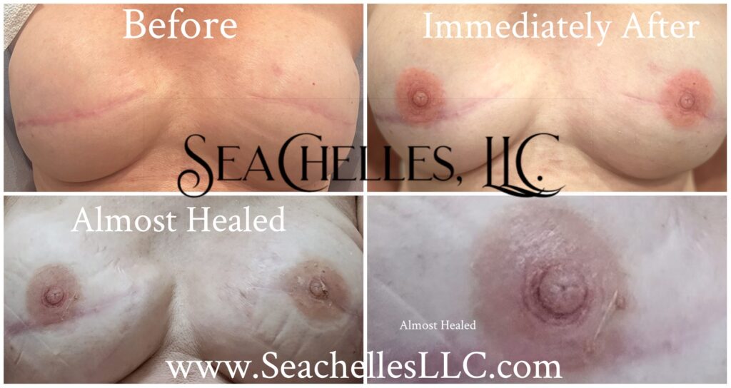 Areola tattooing before, immediately after, and almost healed